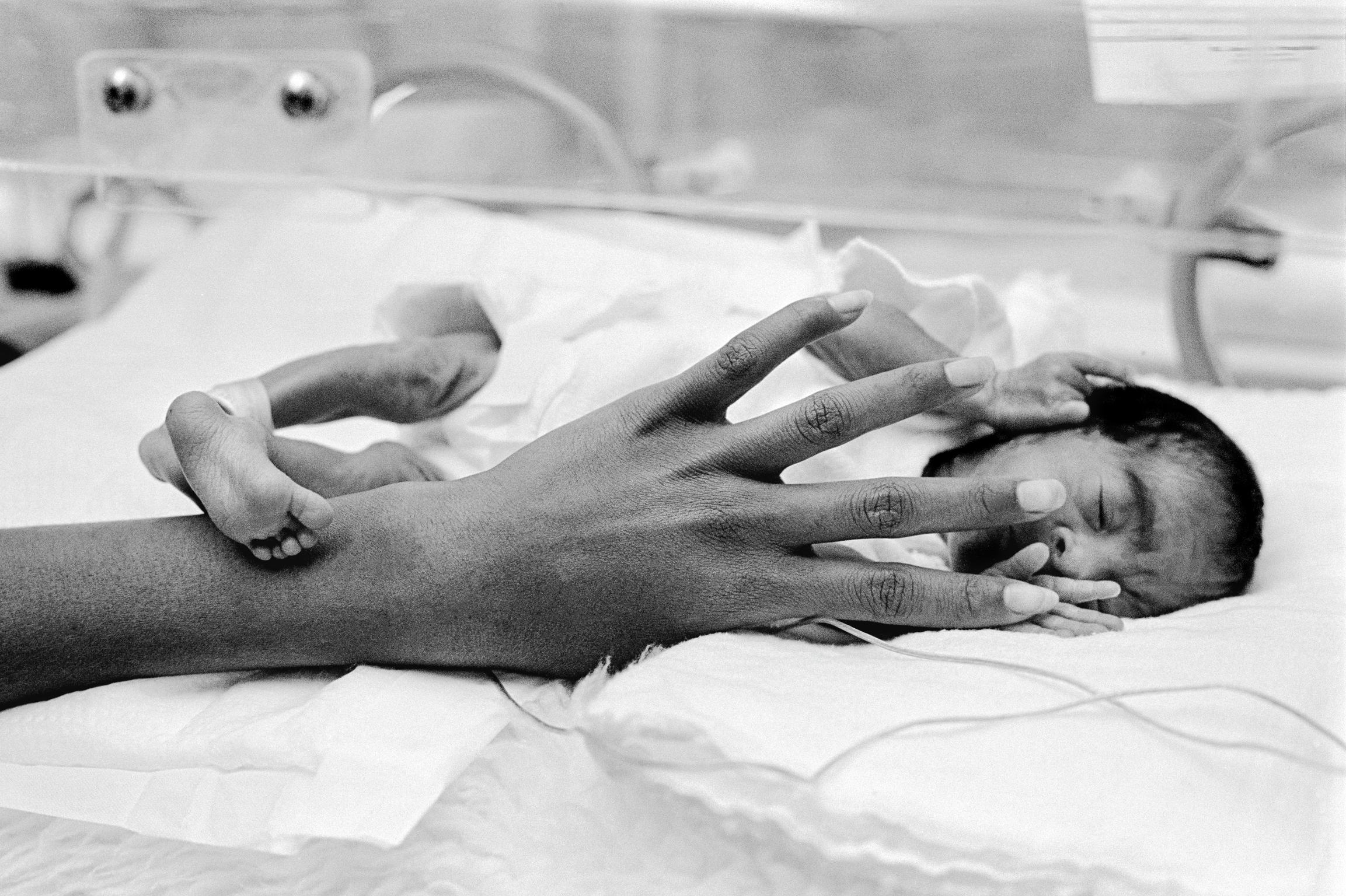 Preemie Baby unit at St Joseph's Hospital. She has a head too large by half for her body. Phoenix, Arizona USA