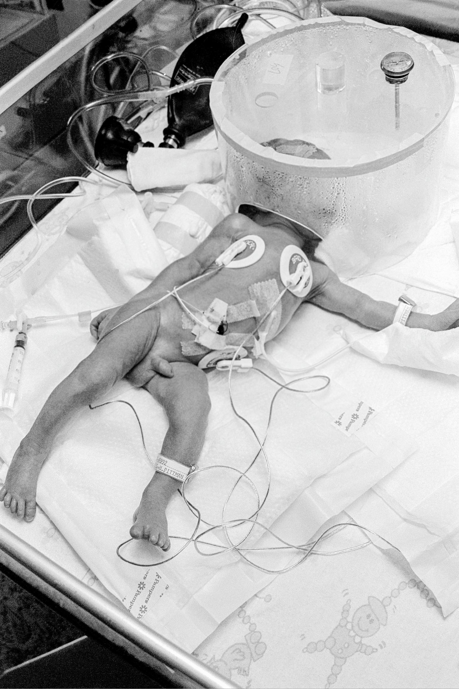 Preemie Baby unit at St Joseph's Hospital. Preemie baby in I.C.U. showing electrode, umbilical catheter, temperature probe and a hood of oxygen at 50% also humidified to reduce irritation. Phoenix, Arizona USA