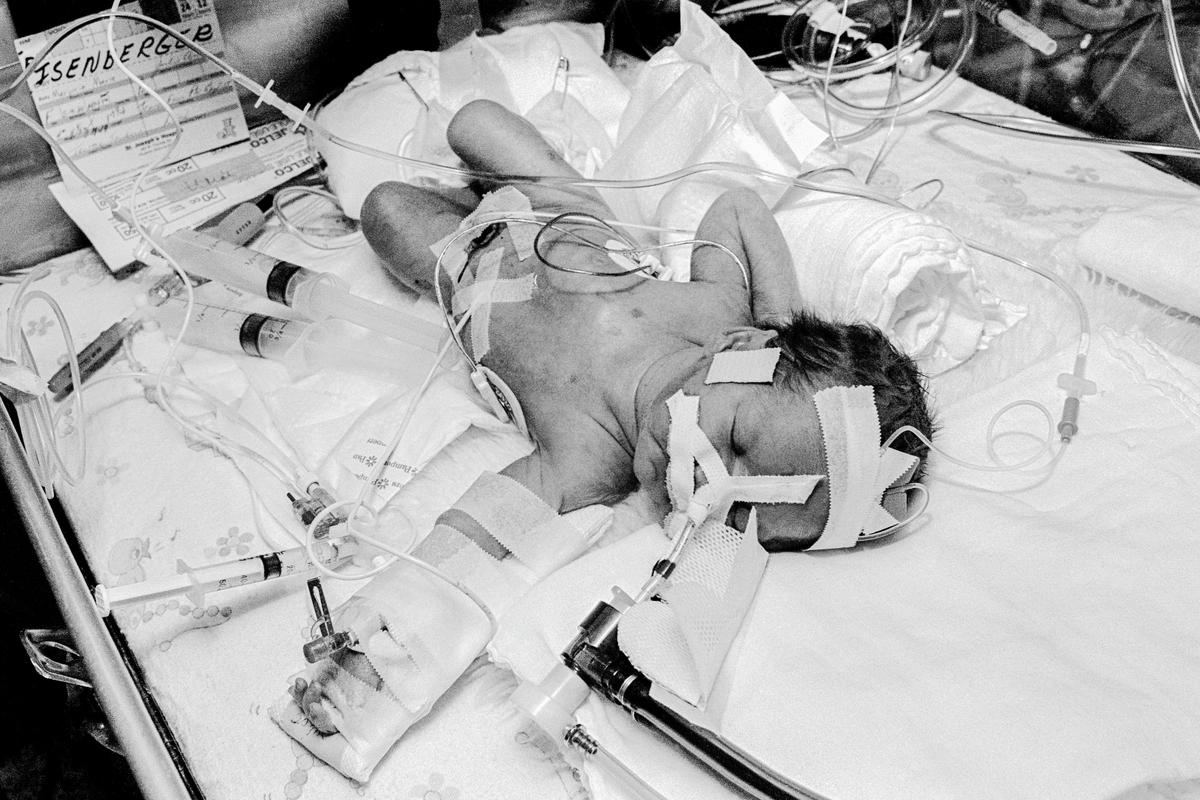USA. ARIZONA. Phoenix. Preemie Baby unit at St Joseph's Hospital. I.C.U. Showing endo-tracteal tube, Umbilical catheter, electrode, and temperature probe.