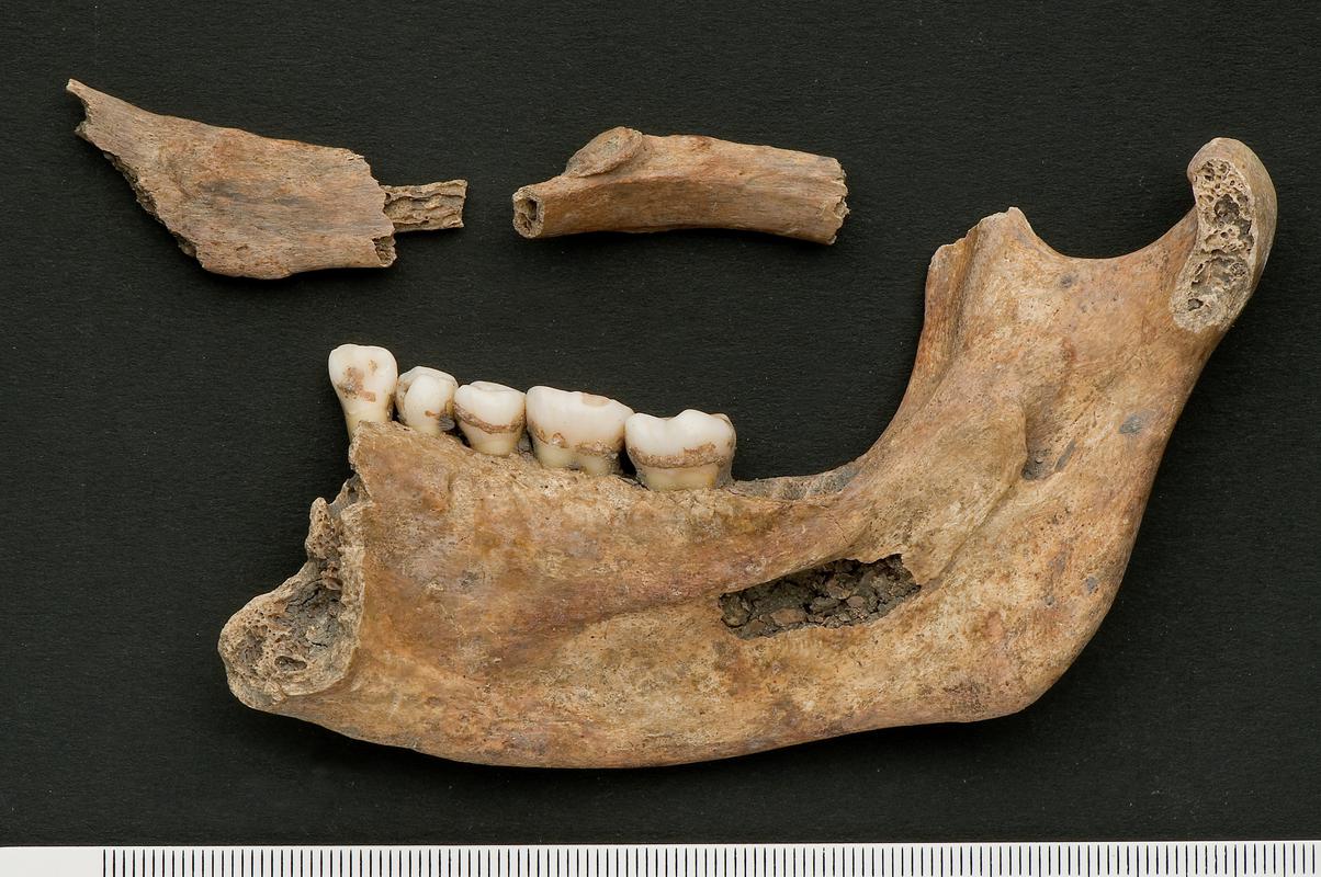 Early Medieval human remains