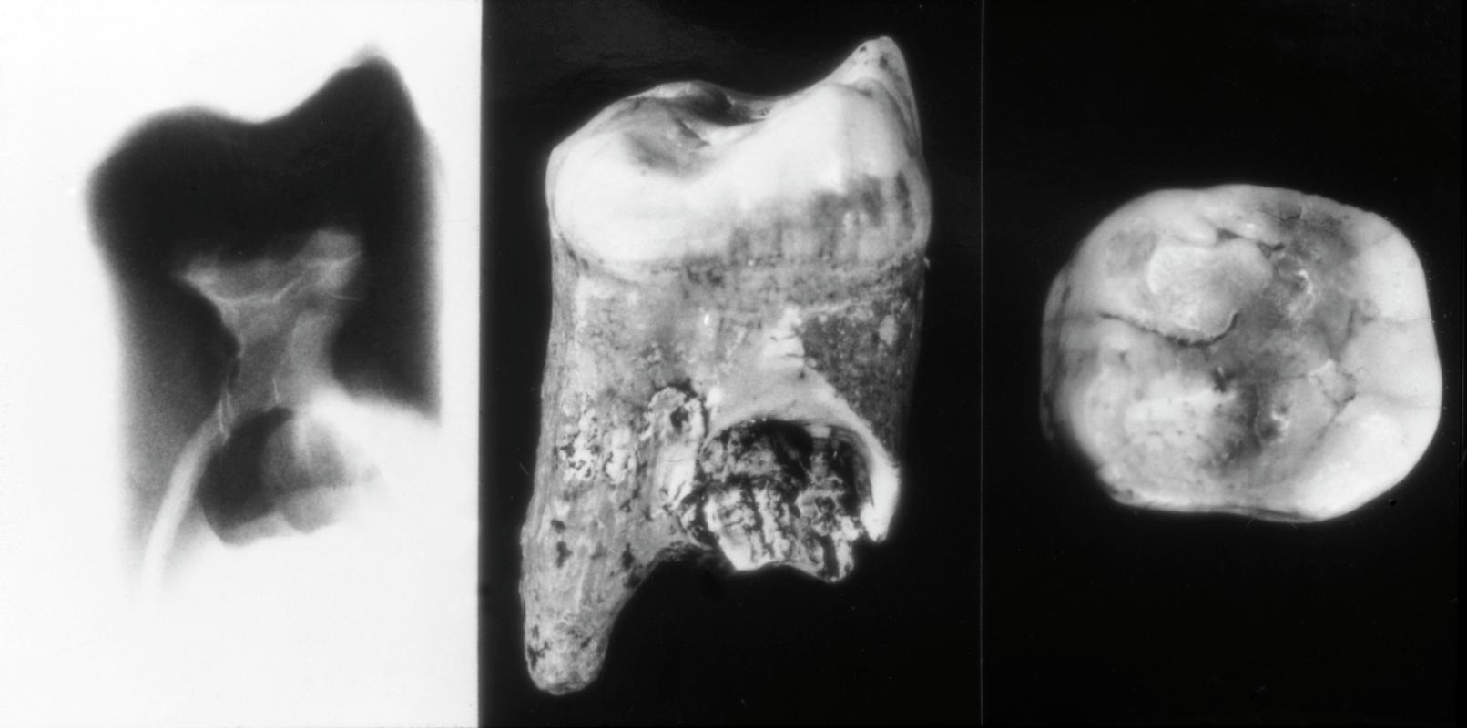 Hominin tooth PN1 with X-rays . Pontnewydd Cave